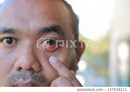 Close up of an Asian man pulling down his lower eyelid with his finger to show a red, bloodshot and inflamed eye. Concept of pink eye, conjunctivitis, allergy, infection and medical eye care. Close up of an Asian man pulling down his lower eyelid with his finger to show a red, bloodshot and inflamed eye. Concept of pink eye, conjunctivitis, allergy, infection and medical eye care. 137838211