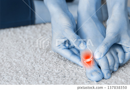 Close up of woman massaging painful big toe with anatomical joint illustration and red highlight. Hallux valgus, gout, bunion and bone inflammation concept for medical health care. 137838350