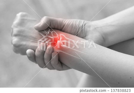Woman massaging her painful wrist with anatomical bone illustration and red highlight. Carpal tunnel syndrome, wrist fracture, arthritis and joint inflammation concept for medical health care. Woman massaging her painful wrist with anatomical bone illustration and red highlight. Carpal tunnel syndrome, wrist fracture, arthritis and joint inflammation concept for medical health care. 137838823