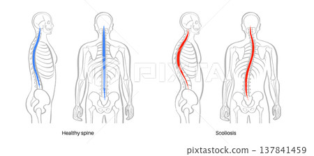 Scoliosis spine deformity Scoliosis spine deformity 137841459