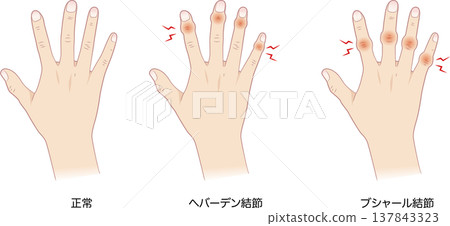 Normal fingers and Heberden's nodes, Bouchard's nodes Normal fingers and Heberden's nodes, Bouchard's nodes 137843323