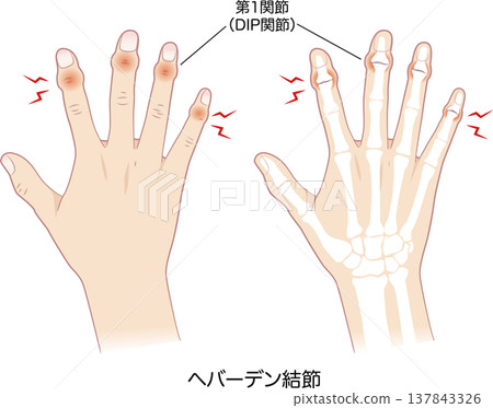 赫伯登結節、右手及其骨骼的症狀 137843326