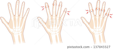 正常的手指和骨骼,包括赫伯登結節和布沙爾結節。 正常的手指和骨骼,包括赫伯登結節和布沙爾結節。 137843327