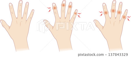 Normal fingers and Heberden's nodes, Bouchard's nodes Normal fingers and Heberden's nodes, Bouchard's nodes 137843329
