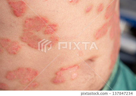 Skin shows red, inflamed patches indicative of psoriasis, a common chronic condition affecting many individuals. The texture reveals severity and irritation. Skin shows red, inflamed patches indicative of psoriasis, a common chronic condition affecting many individuals. The texture reveals severity and irritation. 137847234