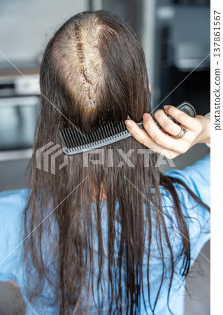 Woman carefully combing hair near surgical scar with staples after craniotomy for brain tumor removal. Postoperative care and recovery routine concept. Woman carefully combing hair near surgical scar with staples after craniotomy for brain tumor removal. Postoperative care and recovery routine concept. 137861567