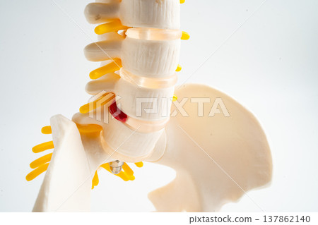 Lumbar spine displaced herniated disc fragment, spinal nerve and bone. Model for treatment medical in the orthopedic department. Lumbar spine displaced herniated disc fragment, spinal nerve and bone. Model for treatment medical in the orthopedic department. 137862140