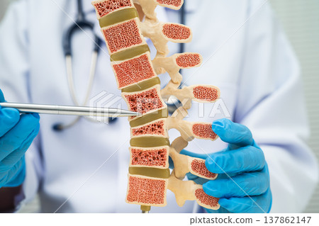 Doctor holding osteoporosis in back bone model. Doctor holding osteoporosis in back bone model. 137862147