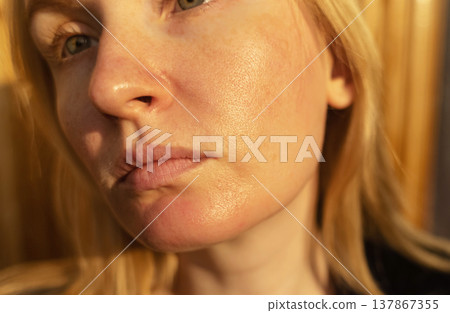 Close-up of female face with enlarged pores and oily skin, visible texture, redness on chin. Natural light beauty portrait, skincare concerns, dermatology concept. Close-up of female face with enlarged pores and oily skin, visible texture, redness on chin. Natural light beauty portrait, skincare concerns, dermatology concept. 137867355