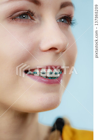 Young woman showing teeth braces Young woman showing teeth braces 137868209