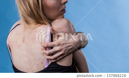 Woman with skin problem acne on back Woman with skin problem acne on back 137868228