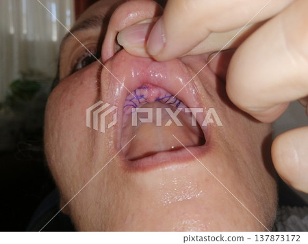 A man with an open mouth and missing all his teeth. Medical sutures on the upper jaw, preparing the oral cavity for dental implants. 137873172