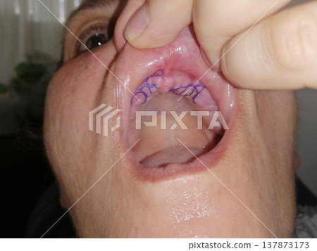 A man with an open mouth and missing all his teeth. Medical sutures on the upper jaw, preparing the oral cavity for dental implants. 137873173
