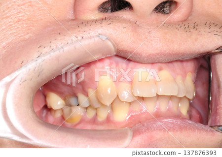 Close up of misaligned teeth and uneven bite inside the mouth showing dental crowding and irregular tooth position recorded in March 2026. Close up of misaligned teeth and uneven bite inside the mouth showing dental crowding and irregular tooth position recorded in March 2026. 137876393