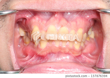 Close up of misaligned teeth and uneven bite inside the mouth showing dental crowding and irregular tooth position recorded in March 2026. Close up of misaligned teeth and uneven bite inside the mouth showing dental crowding and irregular tooth position recorded in March 2026. 137876394