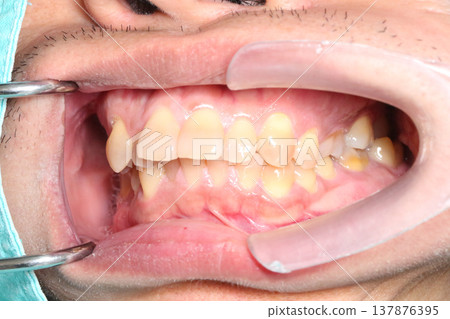 Close up of misaligned teeth and uneven bite inside the mouth showing dental crowding and irregular tooth position recorded in March 2026. 137876395