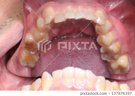 Close up intraoral view using a dental mirror to capture inner teeth and palate showing occlusal surface and detailed oral structure in a clinical setting. 137876397