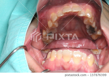 Close up intraoral view using a dental mirror to capture inner teeth and palate showing occlusal surface and detailed oral structure in a clinical setting. Close up intraoral view using a dental mirror to capture inner teeth and palate showing occlusal surface and detailed oral structure in a clinical setting. 137876399