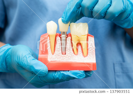 Teeth root dental model with tool for dentist use to cleaning care treatment. Teeth root dental model with tool for dentist use to cleaning care treatment. 137903551