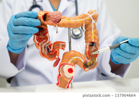 Colorectal cancer, doctor holding intestine colon human anatomy model. 137904664