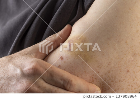 arm with bruises and bruises from a blow, the damaged part of a man's arm with red-yellow bruises and healing scratches arm with bruises and bruises from a blow, the damaged part of a man's arm with red-yellow bruises and healing scratches 137908964