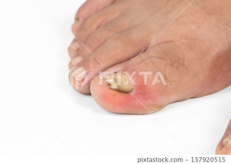 Ingrown toenail on a senior feet with white backgroundClose-up ingrown toenail on senior feet with white background. 137920515