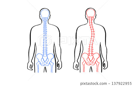 Scoliosis spine deformity Scoliosis spine deformity 137922955