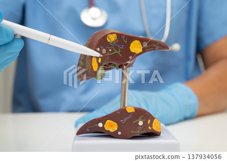 Cirrhosis, Liver cancer, fatty liver, Asian doctor with liver human model. Cirrhosis, Liver cancer, fatty liver, Asian doctor with liver human model. 137934056