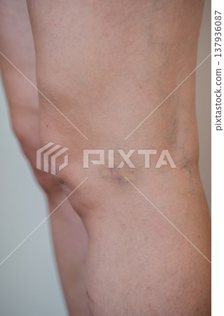 Clinical Evaluation Focusing On Skin Texture And Color Changes In Knee Bruise Area 137936087
