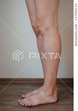 Detailed Depiction Of Knee Scrape Resulting From Fall During City Cycling Adventure Detailed Depiction Of Knee Scrape Resulting From Fall During City Cycling Adventure 137936114