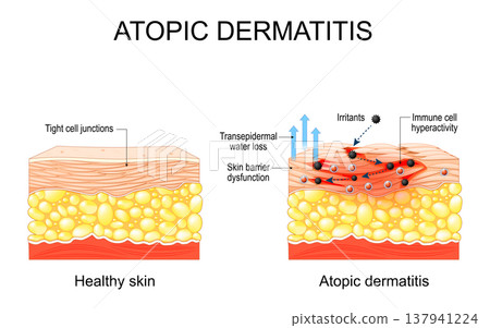 Atopic dermatitis. Atopic eczema. 137941224