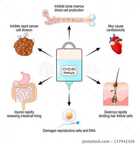 Chemotherapy affects cancer and normal tissues. Chemotherapy side effects. Tumor regression. Chemotherapy affects cancer and normal tissues. Chemotherapy side effects. Tumor regression. 137942388