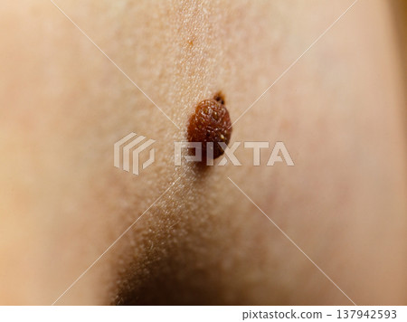 Closeup brown mole on skin. Closeup brown mole on skin. 137942593