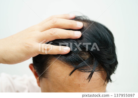 Bald in the middle head and begin no loss hair glabrous of mature man. Bald in the middle head and begin no loss hair glabrous of mature man. 137955097