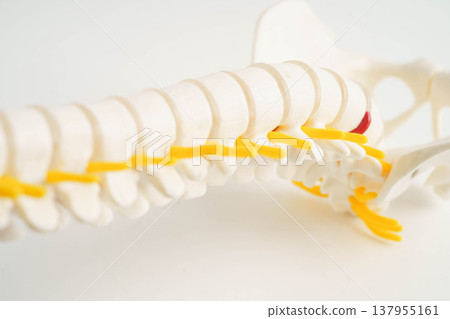 Spinal nerve and bone, Lumbar spine displaced herniated disc fragment, Model for treatment medical in the orthopedic department. Spinal nerve and bone, Lumbar spine displaced herniated disc fragment, Model for treatment medical in the orthopedic department. 137955161