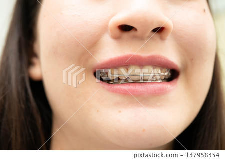 Asian woman wearing Hawley retainer removable orthodontic appliance maintain position of teeth. Asian woman wearing Hawley retainer removable orthodontic appliance maintain position of teeth. 137958354