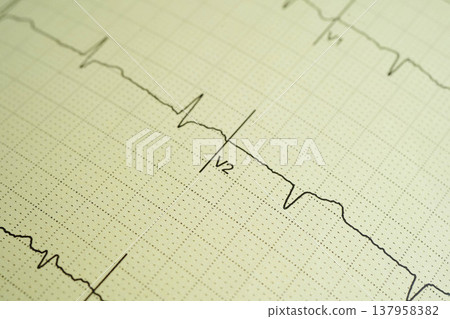 Electrocardiogram (ECG), heart wave, heart attack, cardiogram report. Electrocardiogram (ECG), heart wave, heart attack, cardiogram report. 137958382