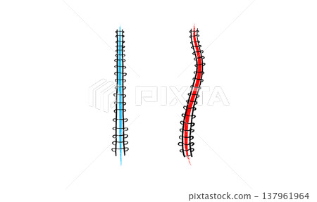Scoliosis spine deformity Scoliosis spine deformity 137961964