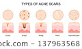Types of acne scars. Cross section of human skin after treatment acne pimples. 137963568