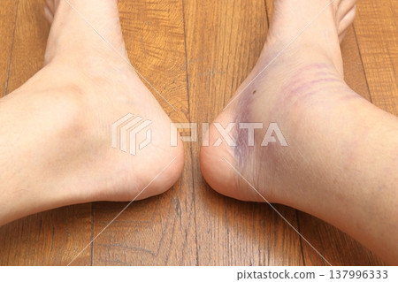 Results of my right calf muscle strain (Day 4) Results of my right calf muscle strain (Day 4) 137996333