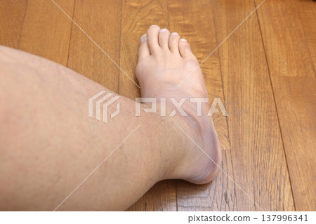 Effects of a calf muscle strain in my right leg (Day 6) Effects of a calf muscle strain in my right leg (Day 6) 137996341