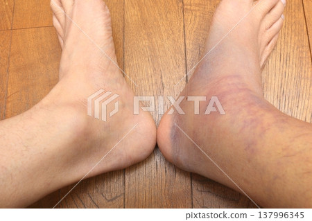 Effects of a calf muscle strain in my right leg (Day 6) Effects of a calf muscle strain in my right leg (Day 6) 137996345