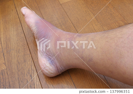 右腿小腿肌肉拉傷的後遺症（第 8 天） 137996351