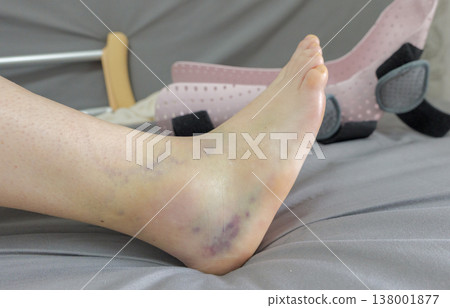 A person's swollen and bruised ankle and foot resting on a grey bedsheet. A person's swollen and bruised ankle and foot resting on a grey bedsheet. 138001877