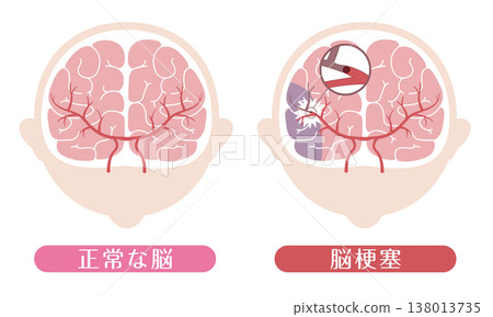 中風後大腦與正常大腦的對比(醫學插圖) 中風後大腦與正常大腦的對比(醫學插圖) 138013735