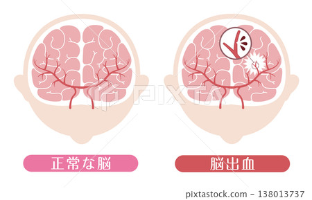 Comparison of a brain with a brain hemorrhage and a normal brain (medical illustration) Comparison of a brain with a brain hemorrhage and a normal brain (medical illustration) 138013737