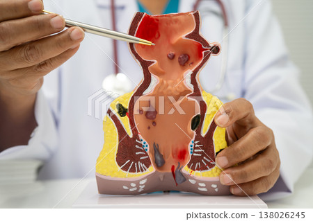 Asian doctor with rectum and hemorrhoid human model, inflamed vascular structure. 138026245