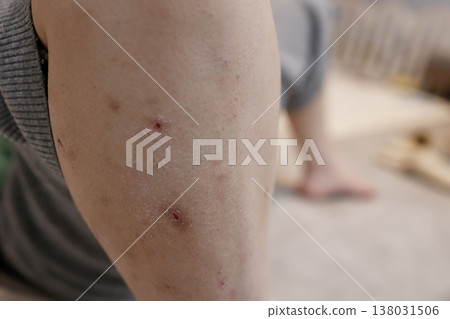 A close-up of a leg with skin wounds and inflammation caused by scratching. A close-up of a leg with skin wounds and inflammation caused by scratching. 138031506