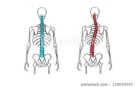 Scoliosis spine deformity Scoliosis spine deformity 138034597
