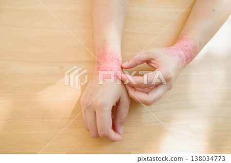 Allergic to rubber gloves, wrist Itching scratching. Itchy red rash, flea allergies, skin diseases 138034773